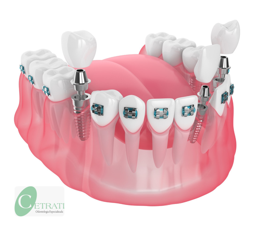 3d render of jaw with implants and orthodontic braces isolated over white background