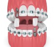 3d render of teeth with orthodontic braces and dental implants. Orthodontic braces concept
